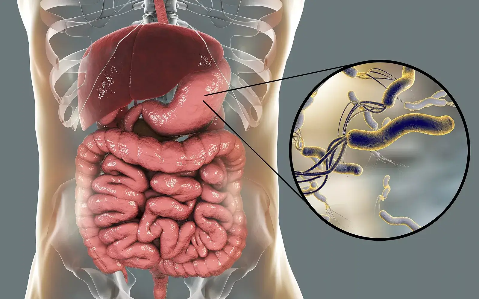 Helicobacter pylori